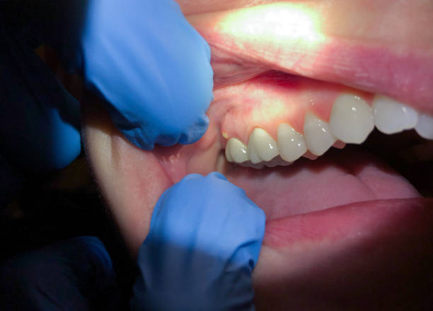Best Emergency Root Canal Treatment in Lackland Af, TX